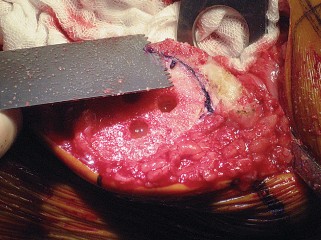 Illustration 48 for Posterior Stabilized Technique: Essential Insights for TKA Success