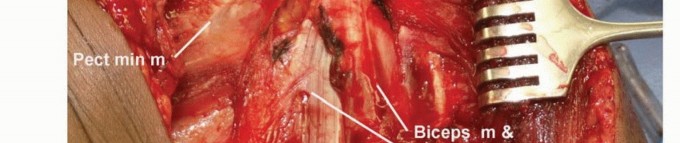 صورة طبية: استئصال أورام الكتف مع الحفاظ على الطرف: أحدث التقنيات لنتائج مثالية مع الأستاذ الدكتور محمد هطيف