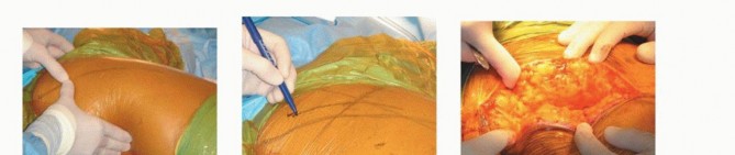 صورة طبية: نصف مفصل الورك: دليلك الشامل لدواعي الاستخدام والأنواع في صنعاء