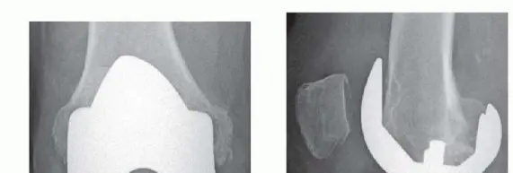 صورة توضيحية لـ علاج فقدان العظم وزراعة العظم في الركبة: دليل شامل للمرضى مع الأستاذ الدكتور محمد هطيف