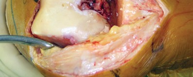 Illustration 16 for Minimize Pain, Maximize Recovery: TKA with Parapatellar