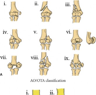 Illustration 3 for Mastering Distal Humerus Fractures: Diagnosis & Treatment