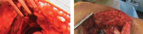 صورة طبية: مفصل الفخذ الصناعي قصير الجذع METHA: حلول مبتكرة للحفاظ على العظم في صنعاء مع الأستاذ الدكتور محمد هطيف