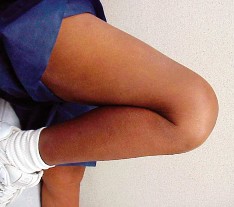 Illustration 82 for Knee Arthroplasty: Avoiding Pitfalls & Benefiting from UKA