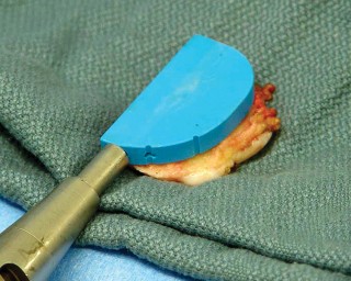 Illustration 45 for Unicompartmental Knee Arthroplasty: Master decisions with this b c figure guide.