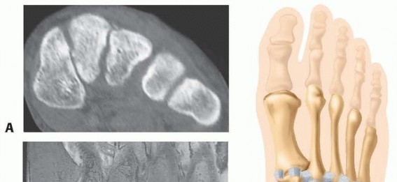 Illustration of fixation of lisfranc - Dr. Mohammed Hutaif