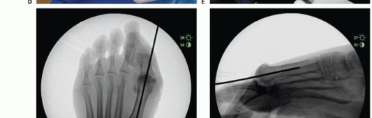 Illustration 19 for End Articular Cartilage Loss: Arthrosurface HemiCAP Resurfacing