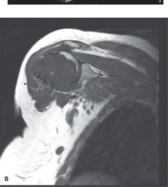 Illustration 2 for Mastering Orthopedics Oncology: Chondrosarcoma Cases