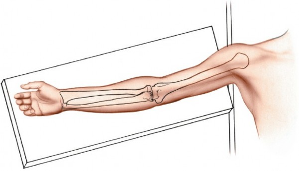 Humeral Shaft Anterior Approach: Master Surgical Techniques