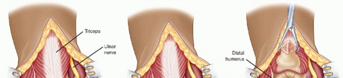 Illustration 47 for Surgical Approaches to Shoulder & Elbow: Pearls and Pitfalls