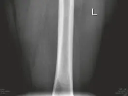 صورة توضيحية لـ خلع مفصل الورك الجراحي لعلاج الاحتكاك الفخذي الحقي: دليل شامل للمرضى