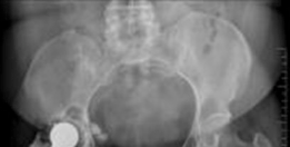 Solving Severe Acetabular Bone Loss with Cup-Cage Reconstruction