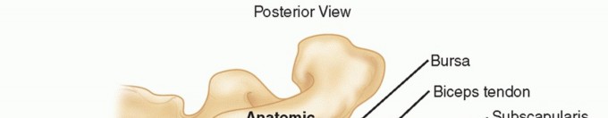 Glenoid Bone Graft for Anterior Shoulder Instability: Restore Stability