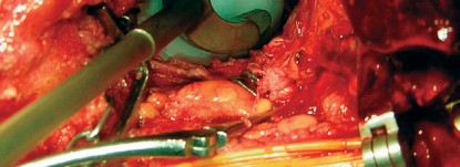 صورة طبية: طول عمر مكون الحُق الأسمنتي في مفصل الورك: مفتاح الاستقرار والديمومة مع الأستاذ الدكتور محمد هطيف في صنعاء