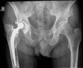 صورة توضيحية لـ تآكل مفصل الورك الصناعي: الأسباب والعلاج في صنعاء | د. محمد هطيف