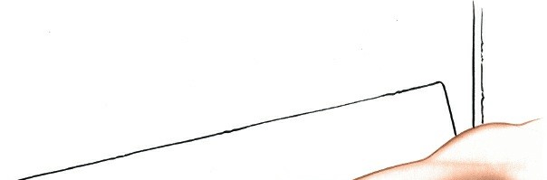 Illustration of column of the distal - Dr. Mohammed Hutaif