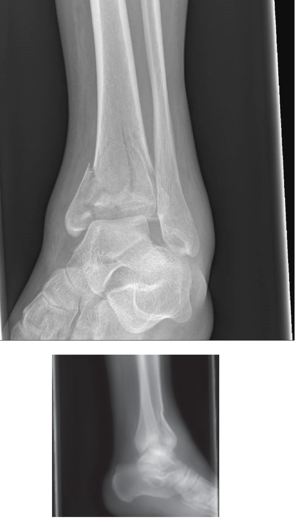 Pilon Fracture Case: Critical Steps for High-Energy Injury