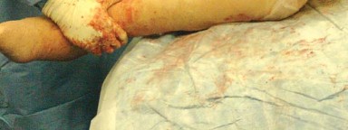 Illustration 19 for Mastering Soft Tissue Balancing for Optimal THR Outcomes