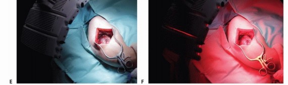 صورة طبية: الاستئصال الموجه لأورام الجهاز العضلي الهيكلي: نهج أكثر أمانًا وفعالية مع الأستاذ الدكتور محمد هطيف