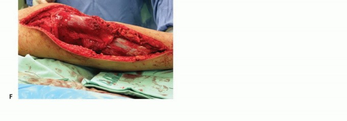 صورة طبية: معالجة الأورام المعقدة في قصبة الساق القريبة حلول الحفاظ على الأطراف