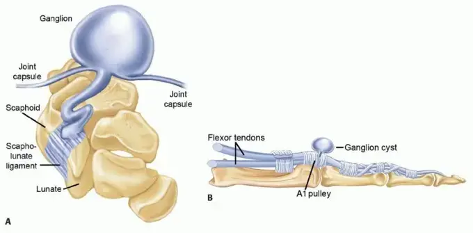 الأكياس العصبية (الزلالية) والأورام الشبيهة باليد والمعصم: دليل شامل للمرضى مع الدكتور محمد هطيف