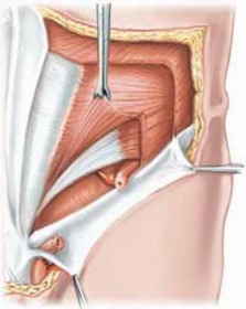 Illustration of athletic pubalgia athletic - Dr. Mohammed Hutaif
