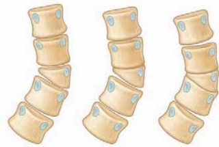Illustration of nerve root retractor - Dr. Mohammed Hutaif