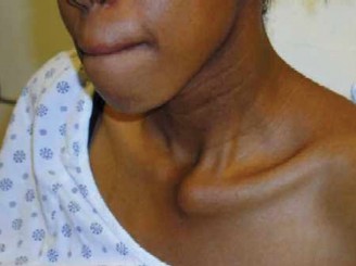 Mastering SC Joint Dislocations: Diagnosis & Treatment Insights