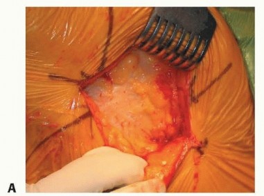 صورة طبية: نصف مفصل الورك: دليلك الشامل لدواعي الاستخدام والأنواع في صنعاء