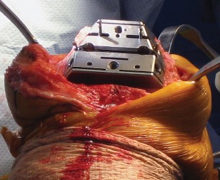 Illustration 29 for Posterior Stabilized Technique: Essential Insights for TKA Success