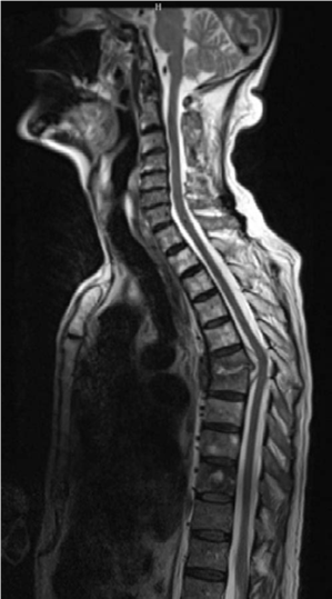 Oral Questions Infection: Your Guide to Spinal Abscess Cases