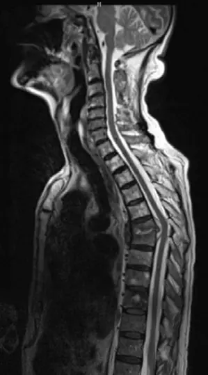 صورة توضيحية لـ خراج العمود الفقري دليلك الشامل للأسباب الأعراض والعلاج مع الأستاذ الدكتور محمد هطيف