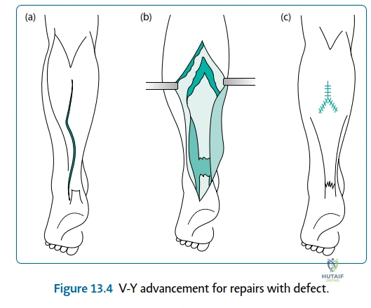 Illustration of postoperative care and instructions - Dr. Mohammed Hutaif