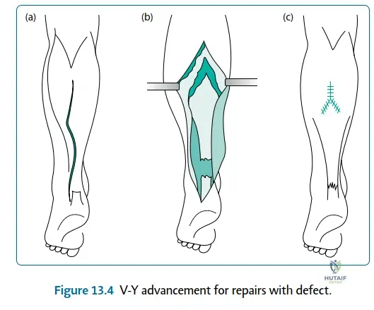 Illustration of postoperative care and instructions - Dr. Mohammed Hutaif