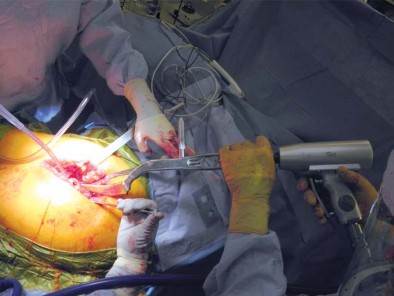 صورة طبية: تقنية الجذع القصير لاستبدال مفصل الورك الكلي: نهج الأستاذ الدكتور محمد هطيف لتدخل جراحي أقل ونتائج أفضل