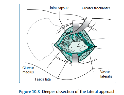 Illustration 38 for Mastering Short External Rotators for Optimal Hip Surgery Results