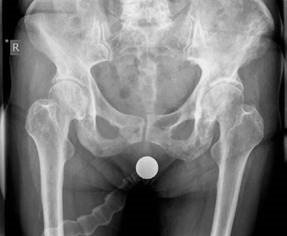 Paget's Disease Candidate: Decoding the Radiograph in Hip Exam
