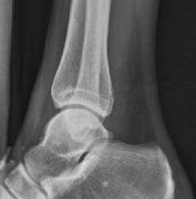Illustration 5 for Tibial Fracture Extending into the Plafond: Intramedullary Secrets