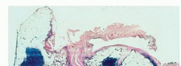 Illustration 8 for Beyond Amputation: Total Femur Resection with Endoprosthetics