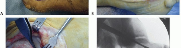 Illustration 8 for Lateral Ankle Repair: Maximize Stability with Interference Screw Fixation
