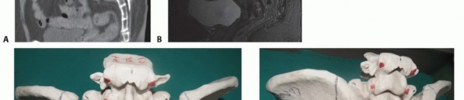 صورة طبية: جراحة أورام العجز: الحفاظ على وظائف الأمعاء والمثانة مع الأستاذ الدكتور محمد هطيف في صنعاء