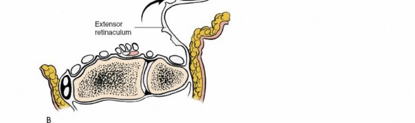 Illustration 14 for Essential Surgical Approaches: Uncover Every Aspect of the Wrist