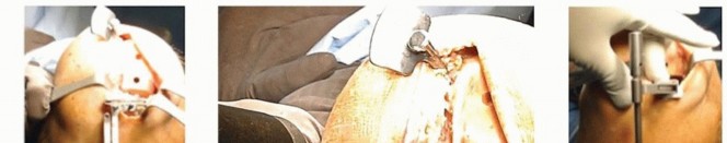 Illustration 11 for Unicondylar Knee Arthroplasty: Is This Your Solution to Knee Pain?