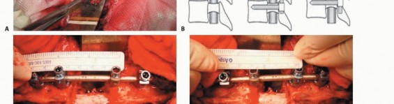 Illustration 31 for Total En Bloc Spondylectomy: Complete Resection for Spinal Tumors