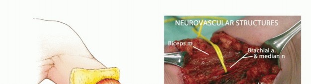 صورة توضيحية لمستويات البتر المختلفة في الذراع