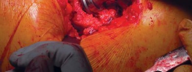 صورة طبية: تقنية الجذع القصير لاستبدال مفصل الورك الكلي: نهج الأستاذ الدكتور محمد هطيف لتدخل جراحي أقل ونتائج أفضل