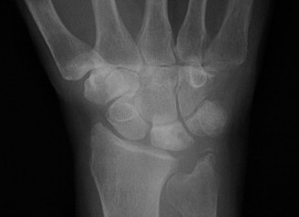 Illustration 7 for Christine M Kleinert Discussion: Solving Difficult Wrist Fractures