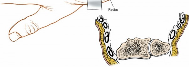 Illustration 27 for Dorsal Wrist Approach: Expert Access to the Column of the Distal Radius