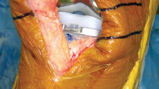 Illustration 34 for Minimize Pain, Maximize Recovery: TKA with Parapatellar