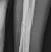 Illustration 4 for Tibial Fracture Extending into the Plafond: Intramedullary Secrets